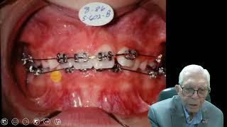 Understanding Adenoids Essential Insights for Pediatric Dentists in Orthodontic Care Case 2 [upl. by Nibuz]