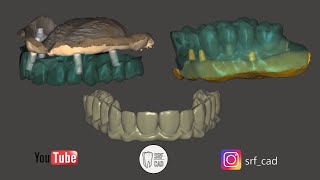 Exocad  Tutorial Da una PTM a una Toronto immediate loading implants [upl. by Harwell]