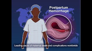 Obstetrics 304 AntePartum Hemorrhage Definition Define APH Causes Bleeding during pregnancy [upl. by Ethyl325]