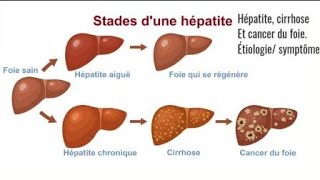 Comprendre la cirrhose du foie avec Docteur Aka Félix [upl. by Glialentn790]