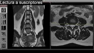 Interpretando una resonancia lumbar  Dolor lumbar [upl. by Farver472]