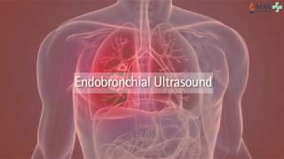 Whats is EBUS  Endobronchial Ultrasound Ebus  Max Hospital [upl. by Prader]