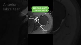 Labral Tear MRI shoulder joint shorts viral youtubeshorts [upl. by Yekcim858]