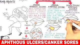 How to Get Rid of a Canker Sore Fast in 24 HOURS [upl. by Eibor]