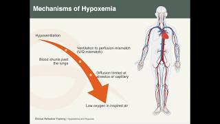 Hypoxemia amp Hypoxia [upl. by Anigar]