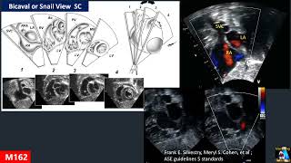 Atrial Septal Defect  ASD amp PFO [upl. by Zindman]