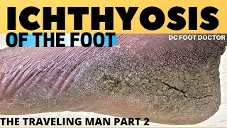 Ichthyosis of the Foot Travelin Mans Severe Skin Condition and Treatment [upl. by Oniluap]