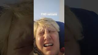 FND seizure aka non epileptic seizure functional neurological disorder [upl. by Pepillo]