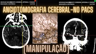 MANIPULAÇÃO ANGIOTOMOGRAFIA CEREBRAL NO PACS DA NOVAEAD [upl. by Lewap]