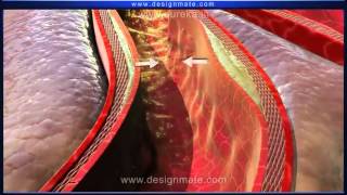 Biologie médicale LAthérosclérose maladie cardiaque  UNIVERA [upl. by Emmett]