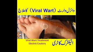 What is Plantar Wart [upl. by Benni626]