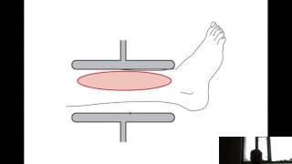 Shortwave Diathermy [upl. by Ytsud]