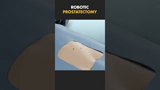 ROBOTIC PROSTATECTOMY [upl. by Irap]