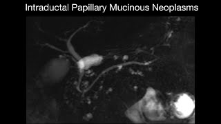 Intraductal Papillary Mucinous Neoplasms [upl. by Ynohtnaluap]