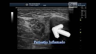 periostitis tibial medial [upl. by Micki]