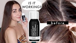 I USED The Inkey List Salicylic Acid Exfoliating Scalp Treatment FOR 2 MONTHS TEST  HONEST REVIEW [upl. by Alper]