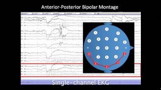 Introduction to EEG [upl. by Kayle]