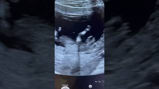 Holoprosencephaly Fetal NT anomaly scan ARDMS Sonography [upl. by Elocel]