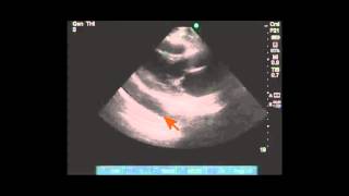 Differentiating pleural vs pericardial effusion by anatomy on echo [upl. by Nwahsud165]