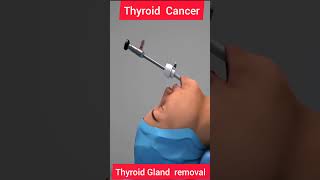 THYROID CANCER  THYROID REMOVAL 3D ANIMATION biologyislife howtogetsuccessinlife getsuccess [upl. by Tserrof]