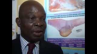 GUINEA WORM DIASEASE IN NIGERIA [upl. by Colman]