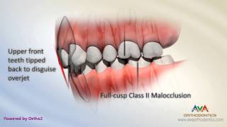 Malocclusion  Class II Div 2 [upl. by Cordeelia655]