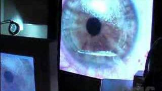 Lasik Eye Surgery [upl. by Folberth]