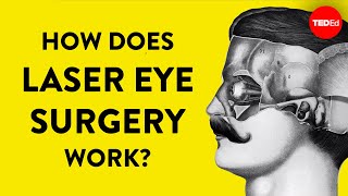 How does laser eye surgery work  Dan Reinstein [upl. by Annayehc139]