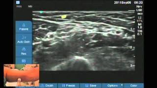 Ultrasound location of Intercostobrachial nerve [upl. by Houlberg]