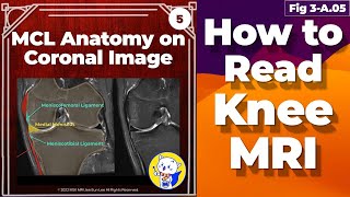 Fig 3A05 Medial Collateral Ligament Anatomy Knee MRI coronal and axial images [upl. by Loux797]