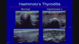 Sonographic Evaluation of Diffuse Thyroid Disease [upl. by Duffy388]