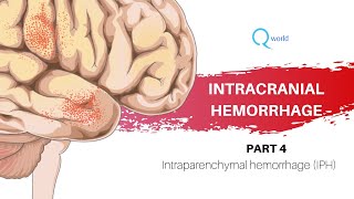 Intracranial hemorrhage Part 4 OF 4  Intraparenchymal hemorrhage IPH USMLE and NEXTNEETPG [upl. by Arocet]