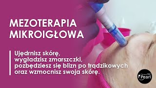 Mezoterapia mikroigłowa  najlepszy zabieg odmładzający [upl. by Enitnelav70]