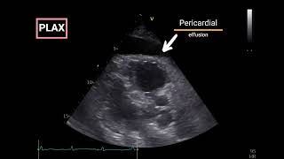 Pericardial Effusion with Doppler Echocardiographic criteria for Tamponade [upl. by Burbank]