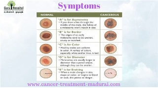 Skin Cancer Treatment in Tamil Nadu  Cancer Treatment Hospital in Madurai [upl. by Galina192]