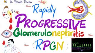 Rapidly Progressive Glomerulonephritis RPGN  Cresenteric  Nephritic Syndrome Subtypes [upl. by Mcnamara]