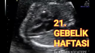 21 gebelik haftasında 5 ayda bebeğe ait detaylı ve açıklamalı ultrason görüntüleri ve Doppler [upl. by Edouard]