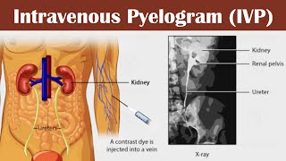 Intravenous pyelogram IVP [upl. by Adrahs]