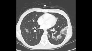 CT CHEST V11 CARDIOGENIC PUL EDEMA EOSINOPHILLIC PN SEPTIC EMBOLI AND BRONCHOPNEUMONIA lungs [upl. by Lanos]