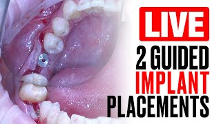 LIVE Guided Dental Implant Surgery [upl. by Yelahs]