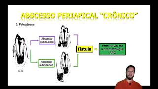 Doenças periapicais Abscesso periapical crônico [upl. by Che]