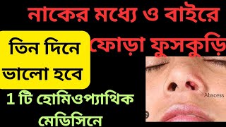 নাকের ফোড়াফুসকুড়ি দ্রুত ঠিক হবে হোমিওপ্যাথিক মেডিসিনে homeopathic medicine for nasal abscess [upl. by Otrebron]