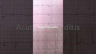 Acute Pericarditis ECG Example 1 [upl. by Duquette]