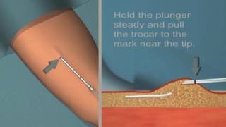 Jadelle insertion and removal Tutorial [upl. by Panther]