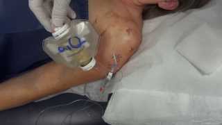 Pain pump removal  shoulder [upl. by Nameloc]