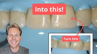 How I Fixed Chipped Front Teeth Full Restoration Process Explained [upl. by Schlessel]