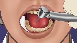 How Cavity Removal Actually Works [upl. by Merchant]