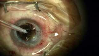 Complex Corneal Transplantation Cataract Surgery Synechialysis [upl. by Nit]