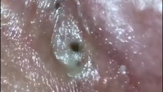 Popping Big Blackheads 😱 [upl. by Richard422]