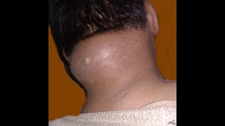 NECK ABSCESS ON ULTRASOUND [upl. by Enorel]